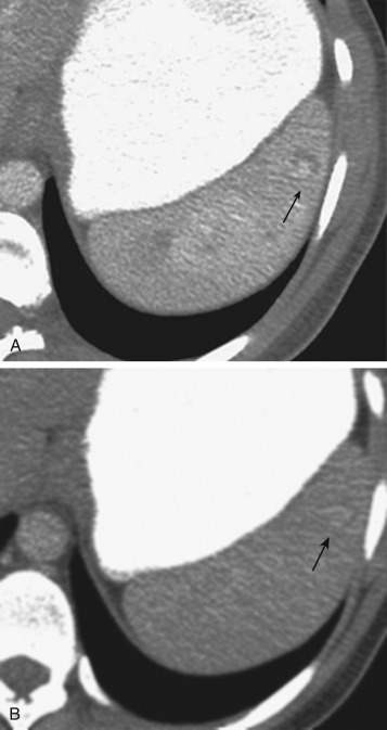 FIGURE 3-19, A contained vascular injury of the spleen, likely a pseudoaneurysm. A, Axial computed tomography obtained during the portal venous phase demonstrates a focal collection of contrast material in the spleen (arrow) with enhancement similar to the aorta. B, The collection of contrast material is contained on the 5-minute delay CT and has decreased in density similar to the aorta (arrow), consistent with the presence of a focal splenic pseudoaneurysm.