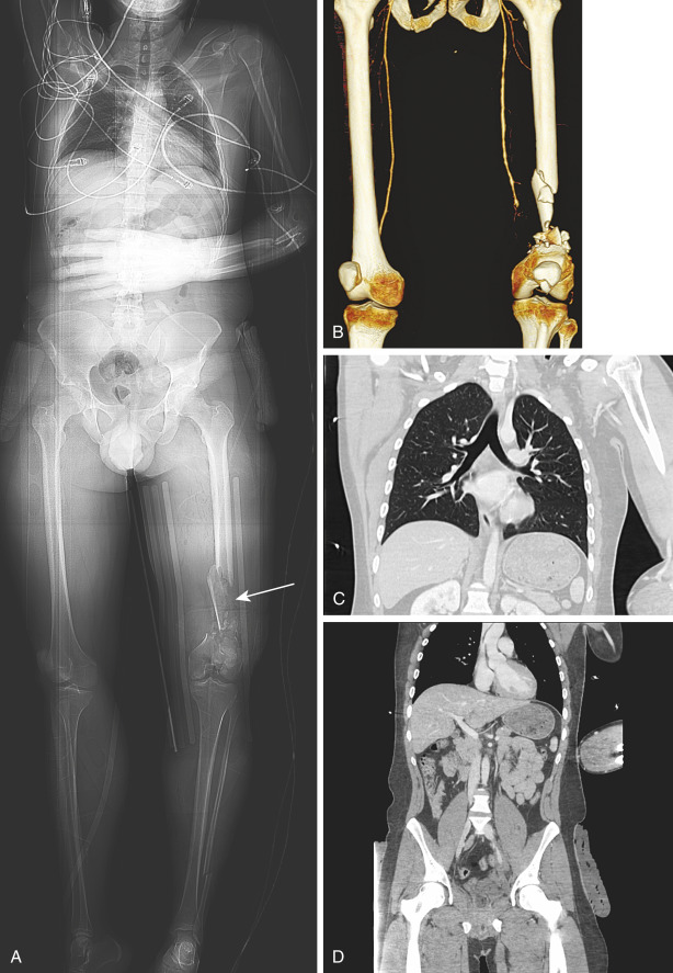 FIGURE 3-2, A 22-year-old man who was in a motor vehicle collision. A, A scout image obtained on a 64-detector computed tomography (CT) scanner. With use of a single scout image, multiple CT studies can be planned, including dedicated CT angiographic studies of focal areas of injury. Note the presence of a distal left femur fracture (arrow) in this patient who sustained significant blunt trauma. B, In this case, CT angiography of the extremities was requested to evaluate the peripheral arteries of the lower extremity. Maximum intensity projection reconstruction demonstrates diffuse vasospasm of the left superior femoral artery with occlusion at the level of the distal femoral fracture. Thoracic ( C ) and abdominal-pelvic ( D ) CT scans were obtained at the same time as the CT angiography. These coronal images reconstructed from the axial dataset were acquired during the arterial and portal venous phases of contrast enhancement, respectively.