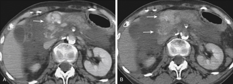 FIGURE 3-3, Active extravasation of contrast material after blunt abdominal trauma. A, Computed tomography (CT) obtained during the portal venous phase shows extravasation of contrast material into the peripancreatic region as a result of an acute vascular injury (arrow) . B, On the 5-minute delay CT, the contrast material continues to diffuse into the soft tissue at the site of injury (arrows) .