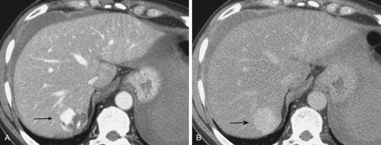 FIGURE 3-4, A hemangioma in a young female patient detected during trauma computed tomography (CT). A, Portal venous-phase CT shows focal puddling of contrast material in the posterior segment of the right lobe of the liver (arrow) . Initially, there was some question as to the presence of a focal liver injury with active bleeding. Free fluid is present adjacent to the liver margin. B, The 5-minute delay CT shows retention of contrast material within a focal liver lesion (arrow) , which excludes a focal liver injury. Instead, the diagnosis of a benign hemangioma was confirmed.