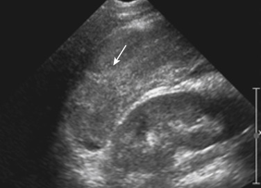 FIGURE 3-5, A liver laceration detected by ultrasound. A sagittal image of the right upper quadrant demonstrates a focal linear echogenic abnormality in the liver, compatible with an acute liver laceration (arrow).