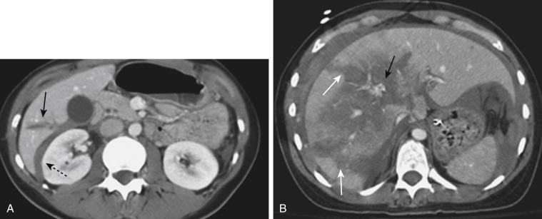 FIGURE 3-6, Computed tomography (CT) depiction of liver lacerations after blunt abdominal trauma. A, A portal venous-phase axial CT image demonstrates a focal liver laceration in the right lobe of the liver (solid arrow) with perihepatic blood in the Morison pouch (dashed arrow). B, Portal venous-phase CT in a different patient after a motor vehicle accident shows a more complex liver laceration (white arrows) with a focal area of active contrast extravasation (black arrow).