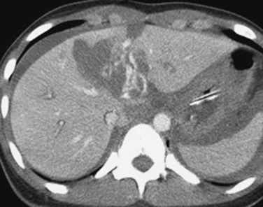 FIGURE 3-8, A portal venous injury after blunt abdominal trauma. An axial computed tomography scan obtained during the portal venous phase shows a complex injury involving the left lobe of the liver with active contrast extravasation. At surgery, a laceration of the left portal vein was detected that required surgical repair.