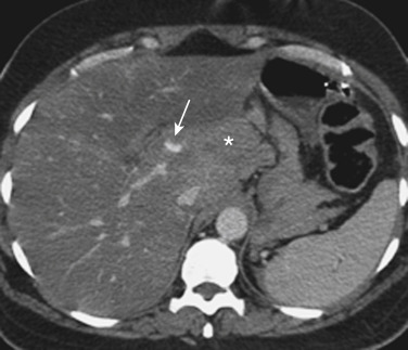 FIGURE 3-9, A hepatic arterial pseudoaneurysm after a motor vehicle accident. An axial computed tomography scan obtained during the portal venous phase shows a large hematoma in the porta hepatis (asterisk) with a small pseudoaneurysm of the left hepatic artery (arrow). Surgical intervention was required to repair a laceration of the left hepatic artery.