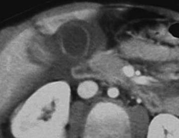 FIGURE 3-10, Avulsion of the gallbladder due to blunt trauma. Computed tomography (CT) obtained during the portal venous phase shows incomplete enhancement of the gallbladder wall with blood adjacent to the gallbladder. The gallbladder appeared inferiorly displaced at the time of CT. At surgery, avulsion of the gallbladder was confirmed, requiring cholecystectomy.