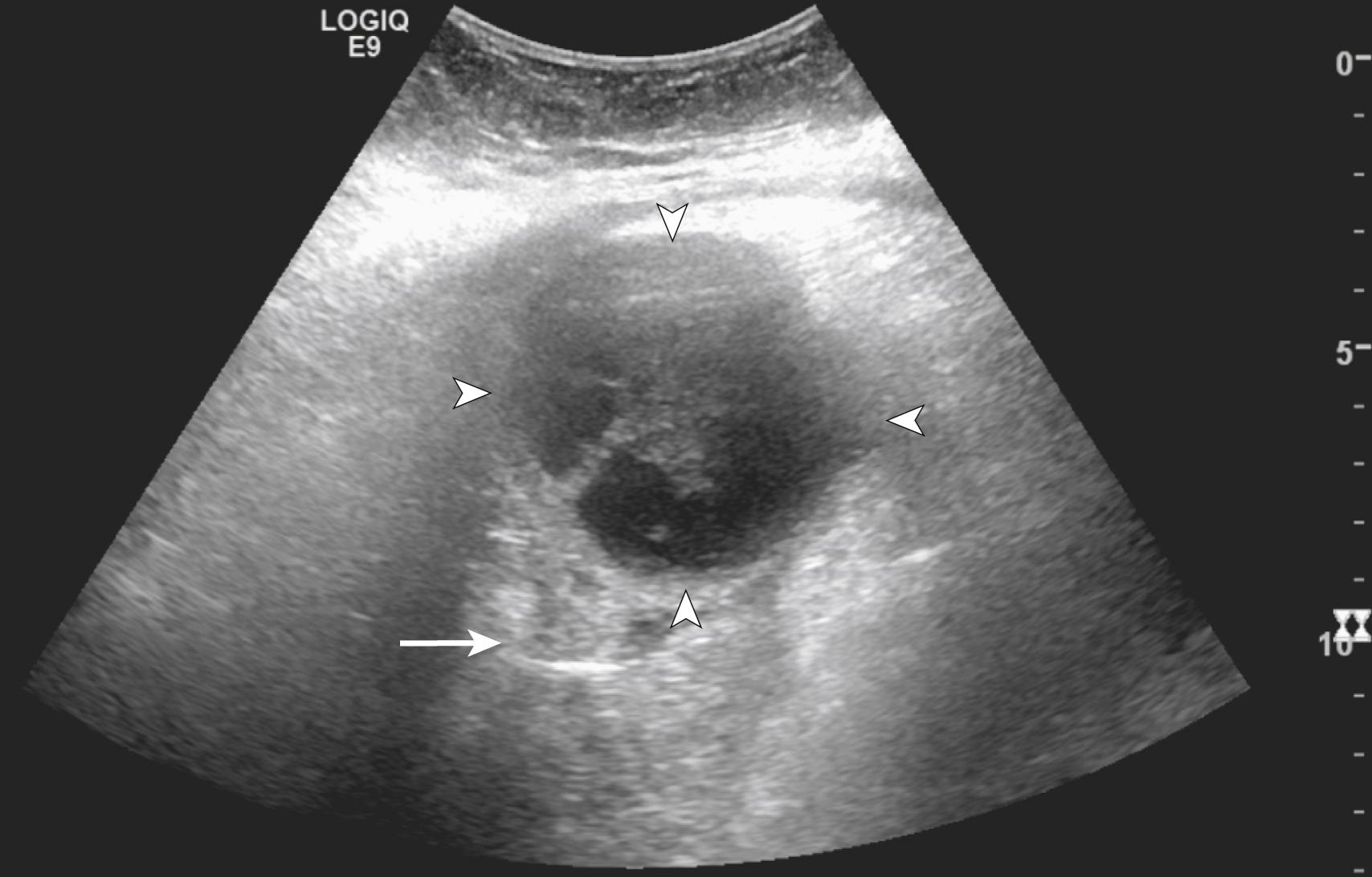 Fig. 29.3, Abdominal US of a typical abscess ( arrowheads ) demonstrating central decreased echogenicity, thickened wall, and debris arising anterior to the descending colon ( arrow ) in a patient with diverticulosis, compatible with a diverticular abscess.