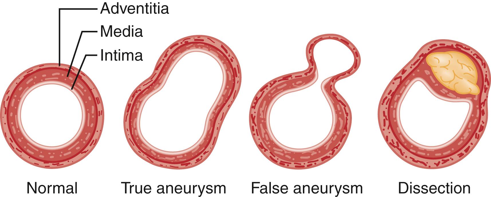 Fig. 72.1, Types of aortic aneurysms.