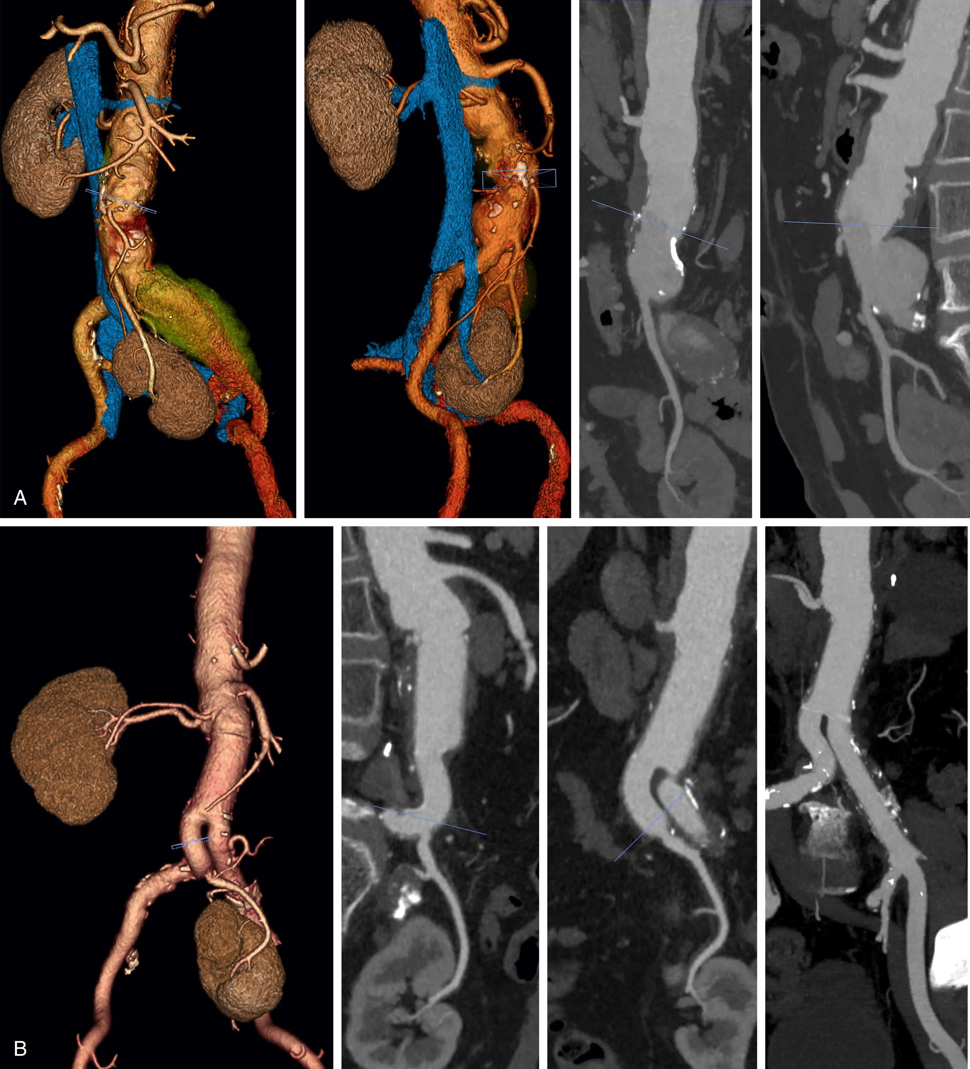 Figure 73.1, A 71-year-old male patient presenting with a 5.0-cm left common iliac artery aneurysm and a 4.8-cm juxtarenal AAA. He has anomalous renovascular anatomy with a small accessory right renal artery and left renal ectopia (pelvic) with a single artery arising from the distal abdominal aorta. ( A ) CTA was reviewed using segmented reconstruction on a 3D workstation, allowing the complex anatomy to be better visualized. The patient underwent open repair with 24 × 12 mm bifurcated PTFE graft with reimplantation of the pelvic kidney artery onto the proximal right limb. A brief period of suprarenal clamping was needed for the proximal anastomosis after which the clamp was transferred to the main body of the graft, allowing the right kidney to be reperfused. We then promptly proceeded with revascularization of the left pelvic kidney. Upon examining the repair configuration and the orientation of left renal artery, it was reimplanted onto the proximal right limb of the graft, which was in turn anastomosed to the proximal right common iliac artery. Lastly, the left limb of the graft was anastomosed to the left common iliac bifurcation. The patient had an uncomplicated postoperative course. ( B ) Follow-up CTA 2 years later shows the repair and left renal artery reconstruction to be widely patent.