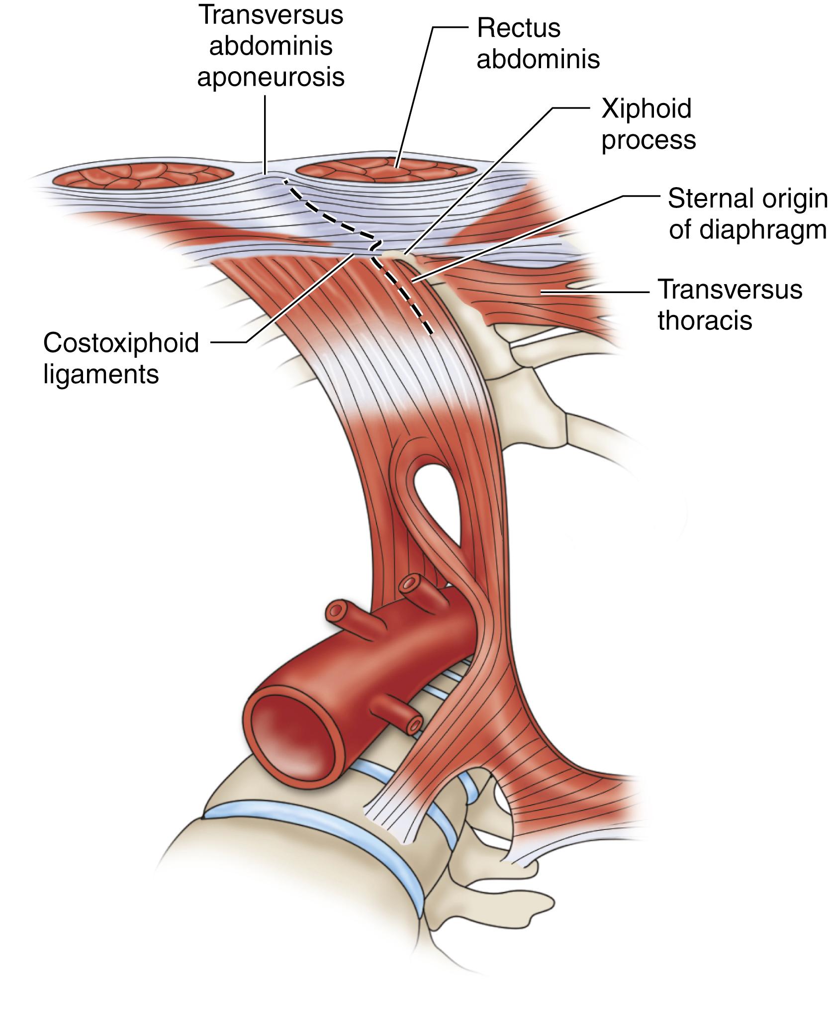 Figure 73.2, The linchpin of upper aortic exposure. When using a midline incision, it is imperative to extend cephalad along the xiphoid process. This maneuver allows transection of the transverse thoracis, anterior diaphragmatic fibers, ventral and dorsal costoxiphoid ligaments, rectus abdominis, and aponeuroses of abdominal muscles. Attention to this detail of the upper incision allows much better cranial exposure facilitating exposure of the paravisceral aorta as well as easier and wider retraction.