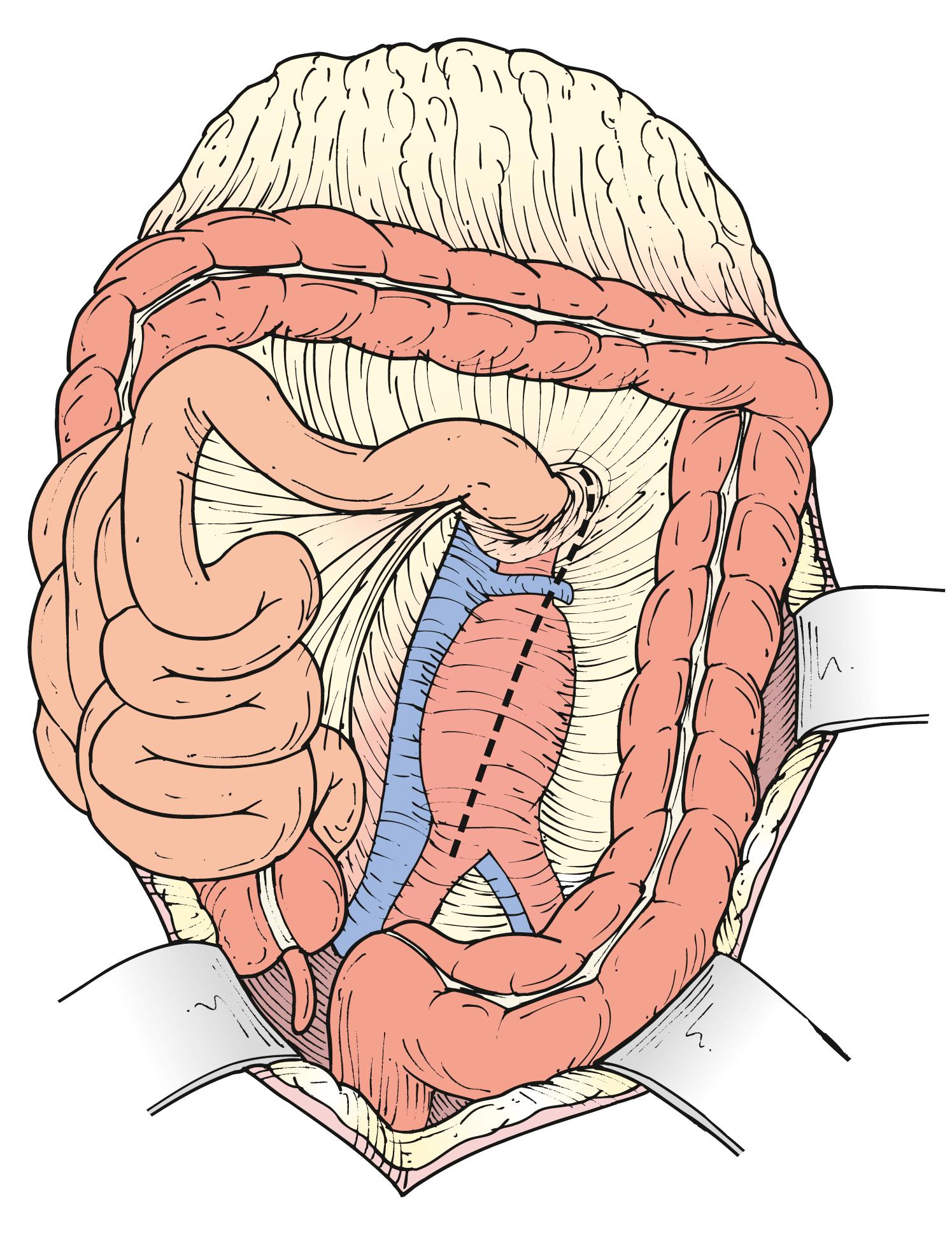 Figure 73.3, The aorta is exposed by incising the overlying posterior peritoneum.