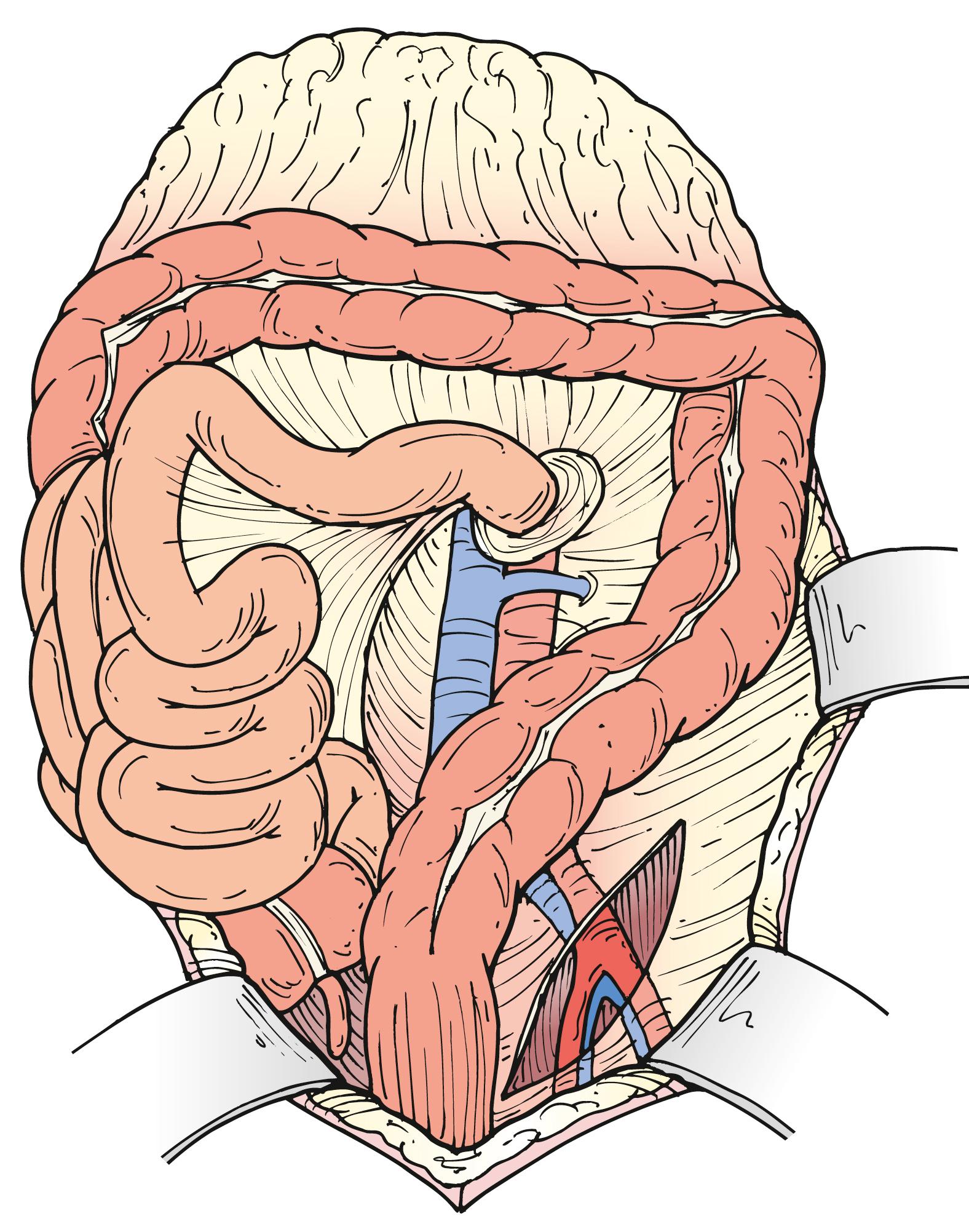 Figure 73.4, The left iliac artery can be accessed by mobilizing the sigmoid colon medially and incising the posterior peritoneum at its base.