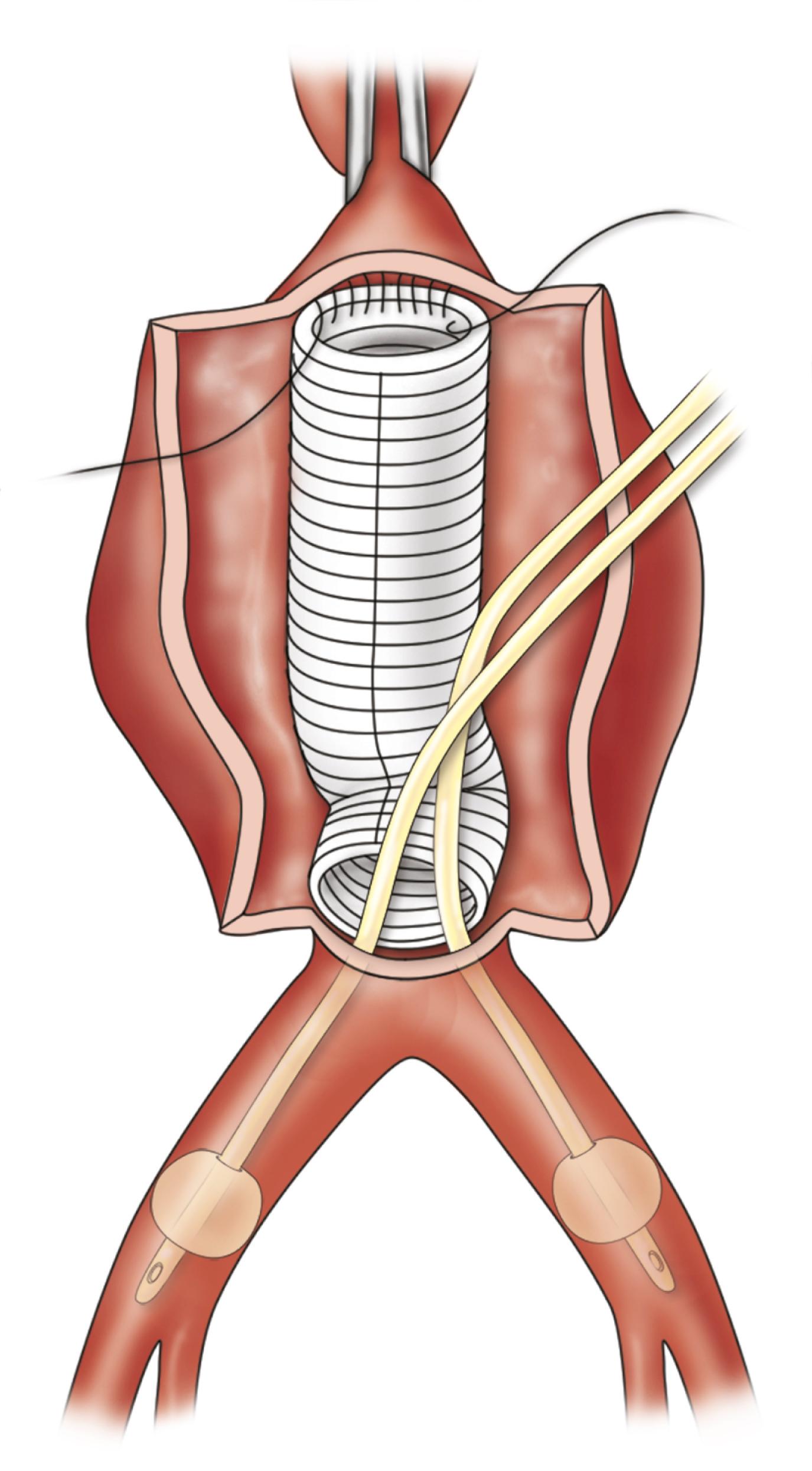 Figure 73.5, Technique of endoluminal control of common iliac arteries. Foley catheters are inserted under direct visualization and inflated enough to arrest back-bleeding.