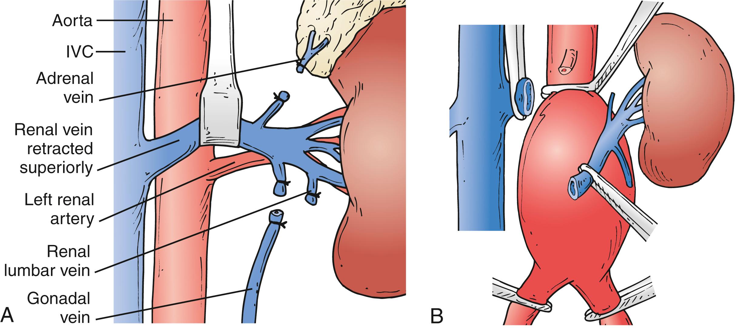 Figure 73.6, The renal vein can be mobilized by dividing it side branches ( A ) or simply divided close to the inferior vena cava (IVC) ( B ).