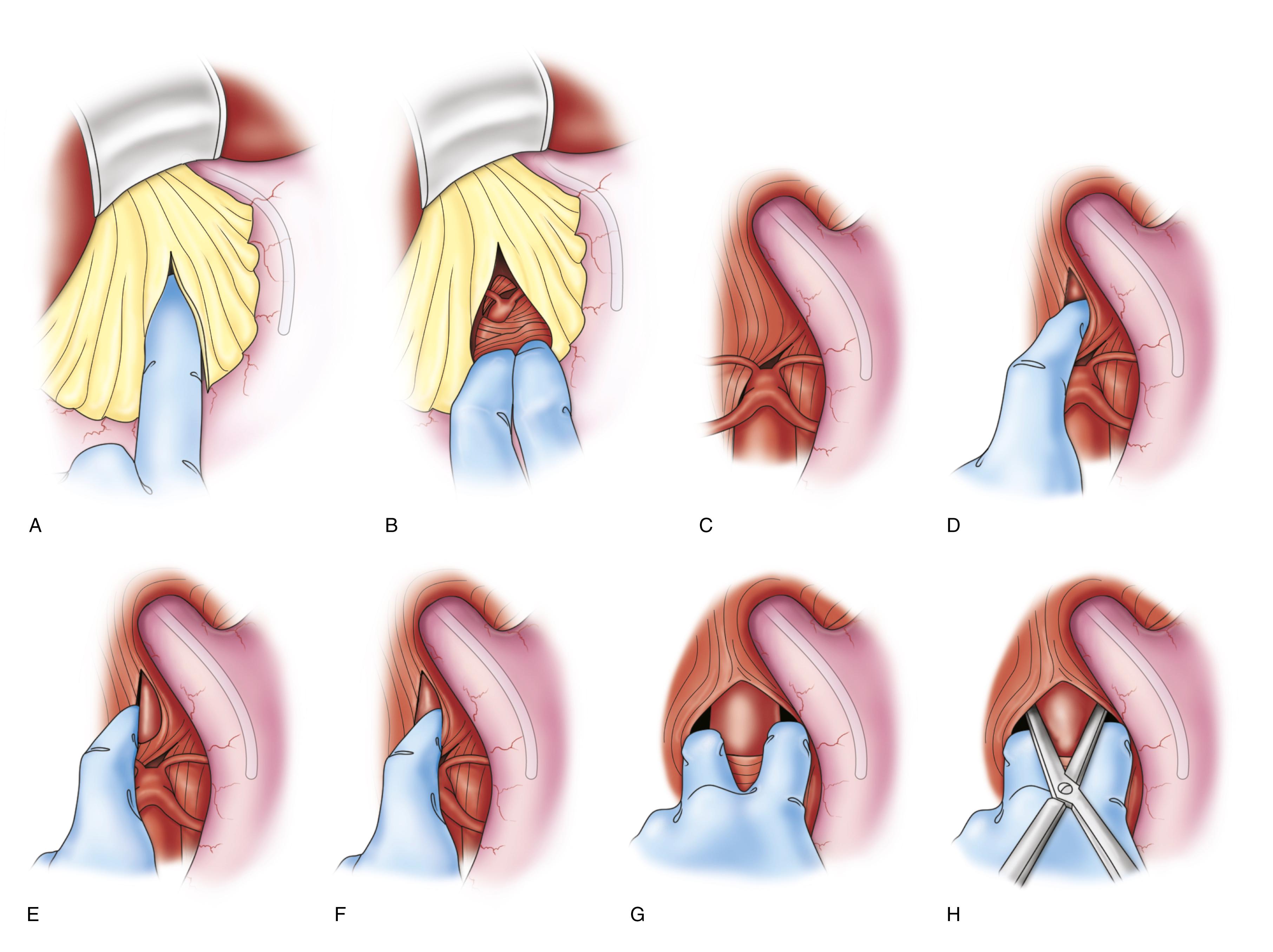 Figure 73.7, Technique of blind digital control and clamping of the supraceliac aorta. The nasogastric tube both protects the esophagus from injury and facilitates periaortic dissection in the presence of a collapsed aorta in a hypotensive patient. ( A,B ) The gastrohepatic omentum underneath the left lobe of the liver is opened bluntly with the digit. ( C ) The esophagus is palpated with the nasogastric tube in place and displaced to the left. ( D ) The right crus of the diaphragm is incised digitally using repeated longitudinal sweeps with the digit to expose the anterior surface of the aorta, which may or may not be pulsate dependent on the patient’s hemodynamic condition. ( D–F ) Additional controlled blunt finger dissection is used to free up the anterior and lateral surfaces of the aorta. (G,H) The clamp is guided over two fingers against the anterior aspect of the vertebral bodies and the aorta can then be clamped.