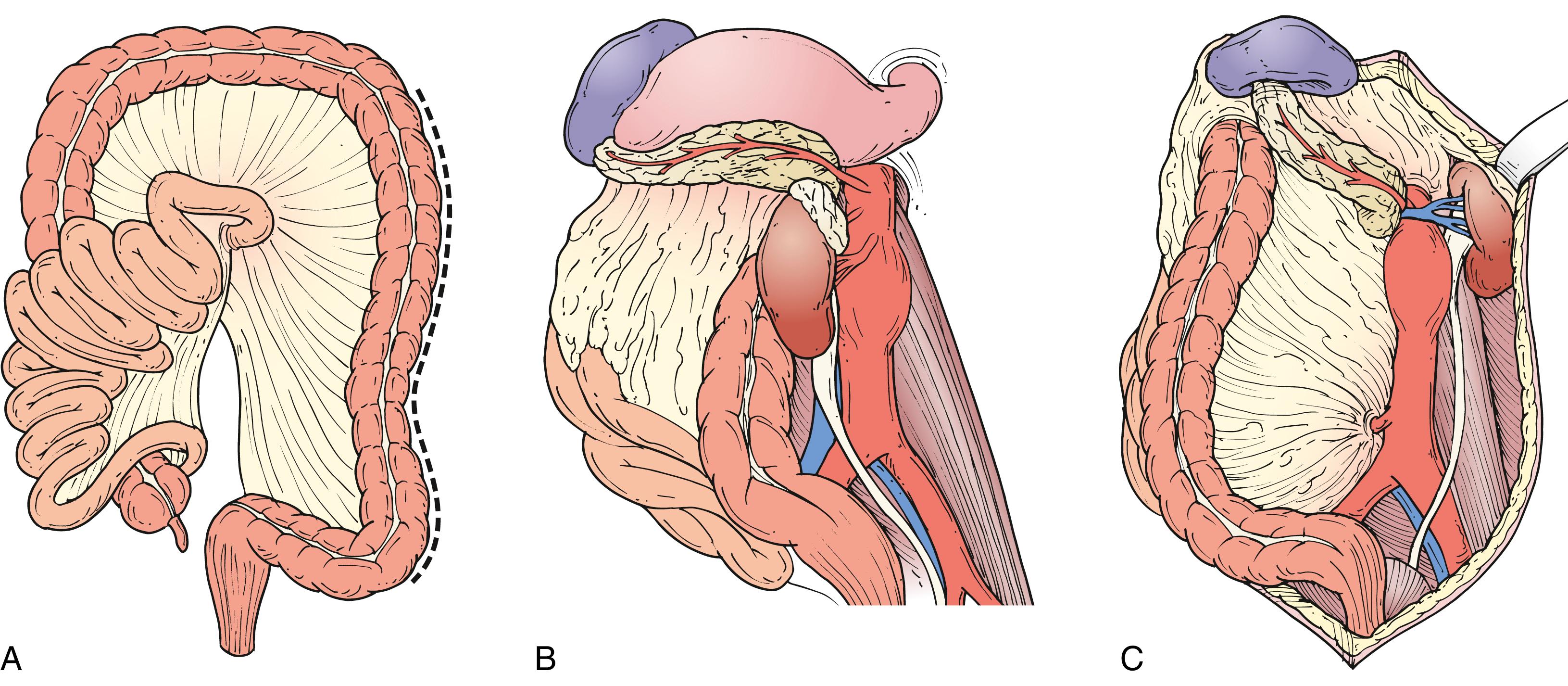 Figure 73.8, When using the transperitoneal approach, a left medial visceral rotation facilitates access to the visceral segment of the aorta. The peritoneum is incised along the line of Toldt ( A ) and the left colon, pancreas, and spleen are mobilized medially. The kidney can be mobilized en bloc ( B ) or left in the renal fossa ( C ).