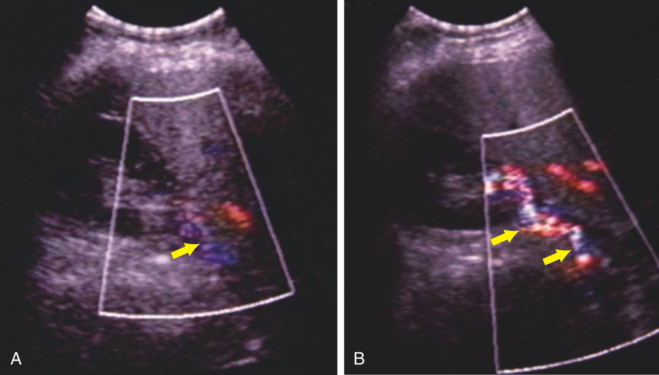 Fig. 17.1, Color Doppler imaging of a patient’s right renal artery before (A) and after (B) administration of a vascular ultrasound contrast agent. Note the increased visualization of flow in the renal artery ( arrows ) after intravenous injection of contrast. In this case, no vascular abnormality was detected.