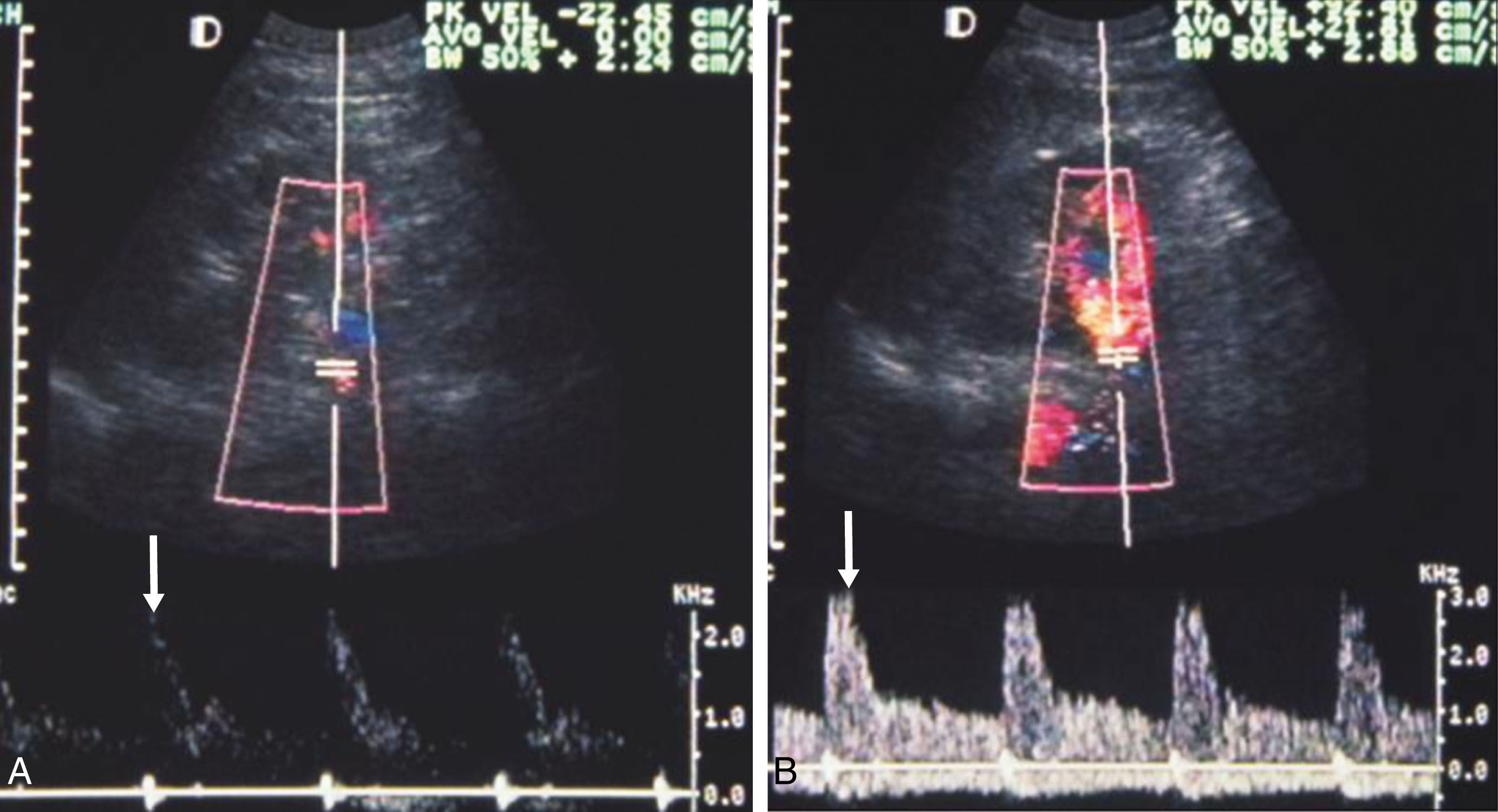 Fig. 17.2, Color flow imaging and spectral Doppler analysis of renal artery flow. (A) Before contrast, the spectral waveforms are weak, and there is minimal color flow information. (B) After intravenous administration of a contrast, the spectral wave forms have a higher signal intensity, and additional color flow information is provided.