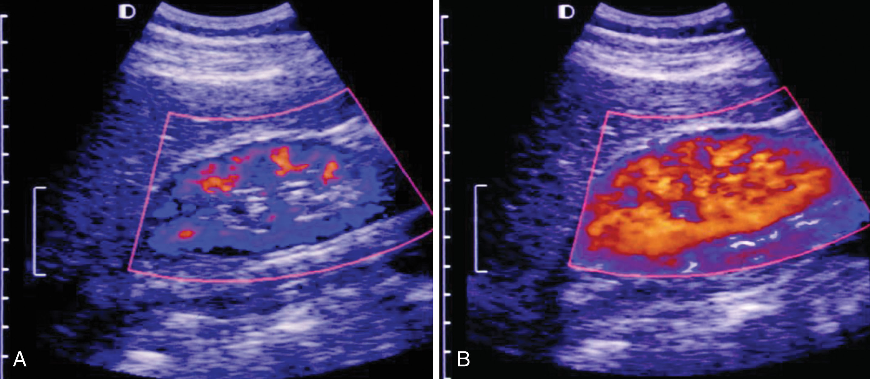 Fig. 17.3, Power Doppler imaging of a normal right kidney before (A) and after (B) injection of a vascular ultrasound contrast agent. Note the improved demonstration of flow in the renal parenchyma after intravenous injection of contrast.