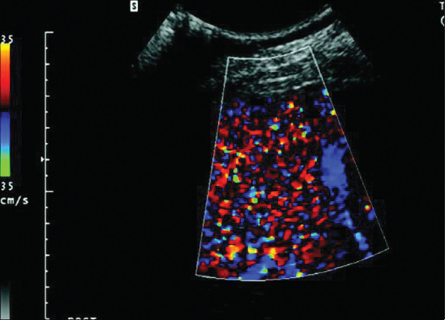 Fig. 17.4, Color Doppler imaging display of acoustic emission after intravenous injection of a tissue-specific ultrasound contrast agent. The rupture of contrast microbubbles present within the reticuloendothelial system cells of the liver results in the characteristic random color display.