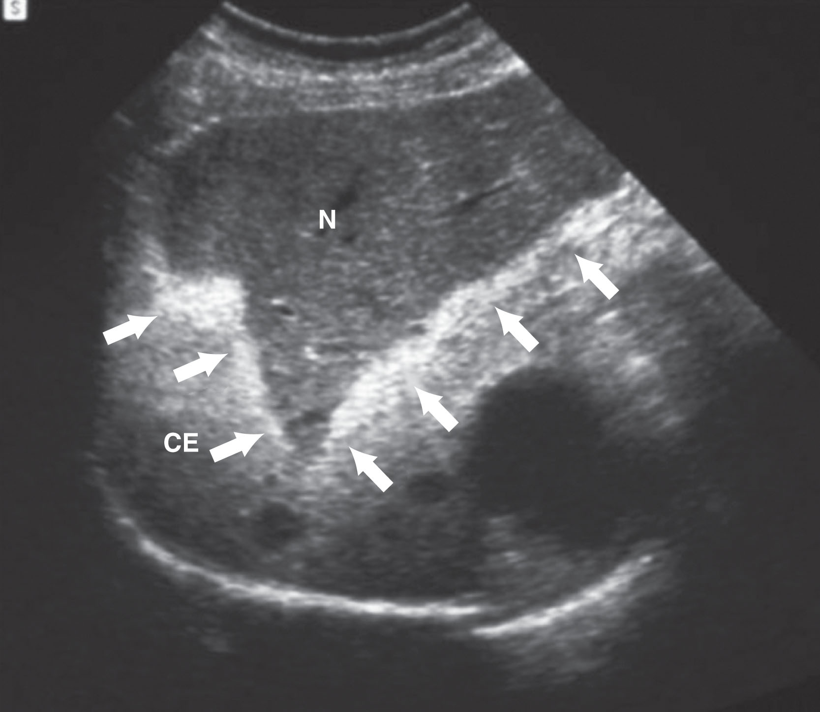 Fig. 17.5, Gray-scale contrast harmonic imaging display of the acoustic emission effect after intravenous injection of a tissue-specific ultrasound contrast agent. As the acoustic energy traverses through the liver parenchyma, it causes the contrast microbubbles to rupture, resulting in a characteristic wave of intense echoes ( arrows ). The normal echogenicity of the liver parenchyma in the near field (N) is restored after the microbubbles have ruptured, whereas deep to the acoustic emission wave, the contrast-enhanced tissue (CE) remains echogenic because of the presence of intact microbubbles. This effect is dramatic when visualized in real time.