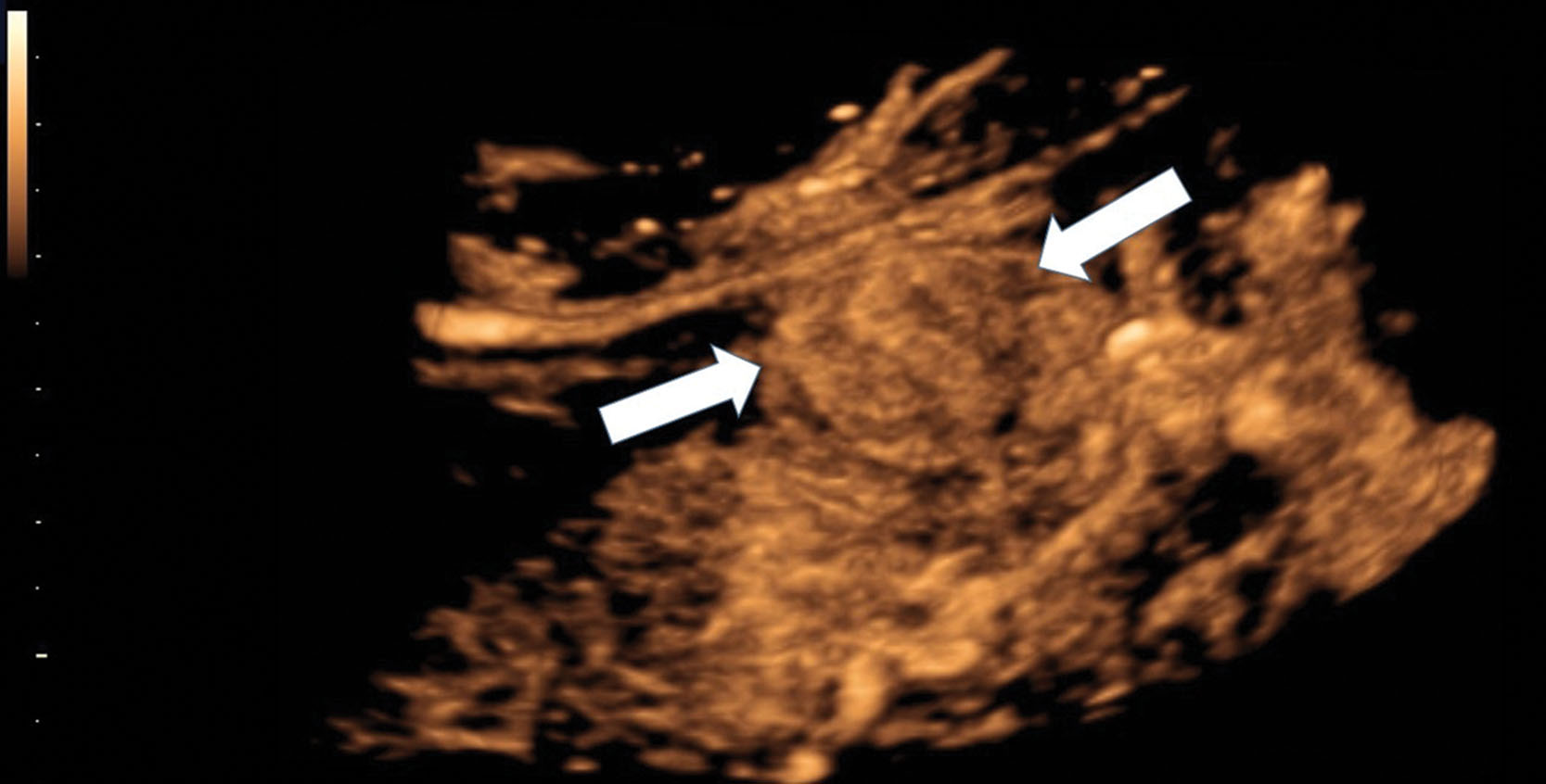 Fig. 17.6, Contrast-enhanced 4D coded harmonic imaging of hepatocellular carcinoma (arrows) prior to locoregional treatment. Volume data image reconstruction software is used to better appreciate the mass and feeding vasculature.