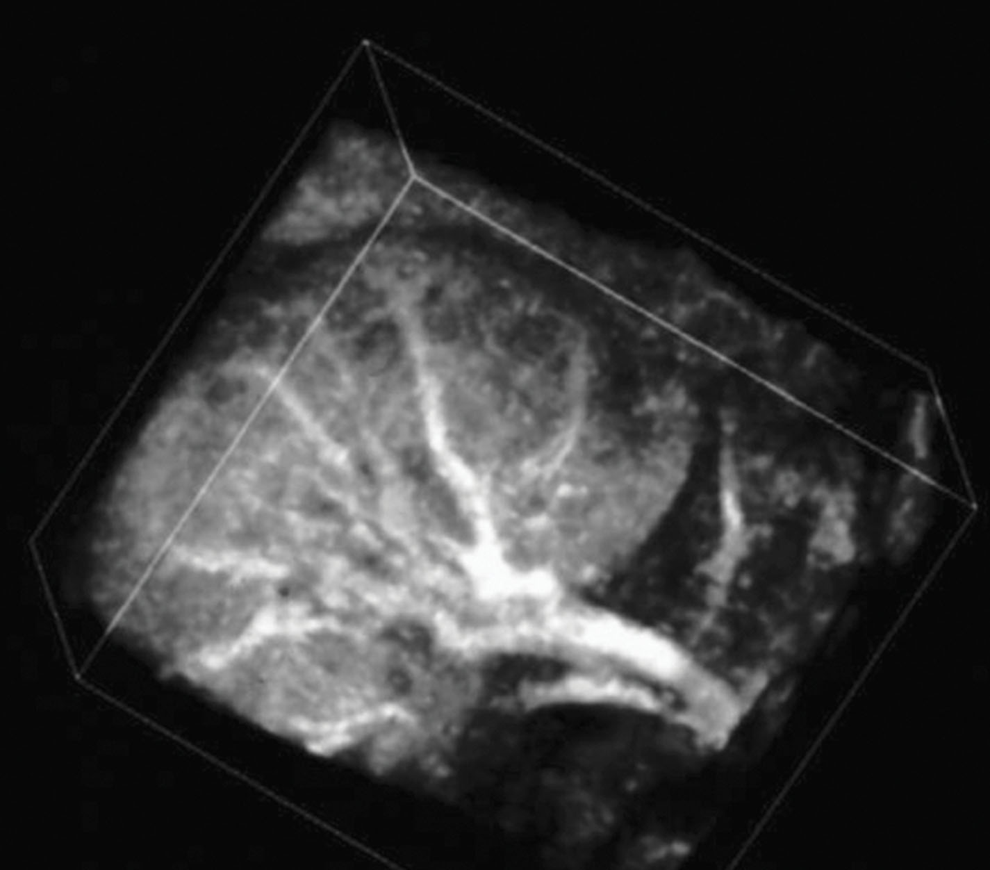 Fig. 17.7, The combination of 3D gray-scale harmonic imaging and administration of a vascular ultrasound contrast agent results in an “ultrasound angiogram.”