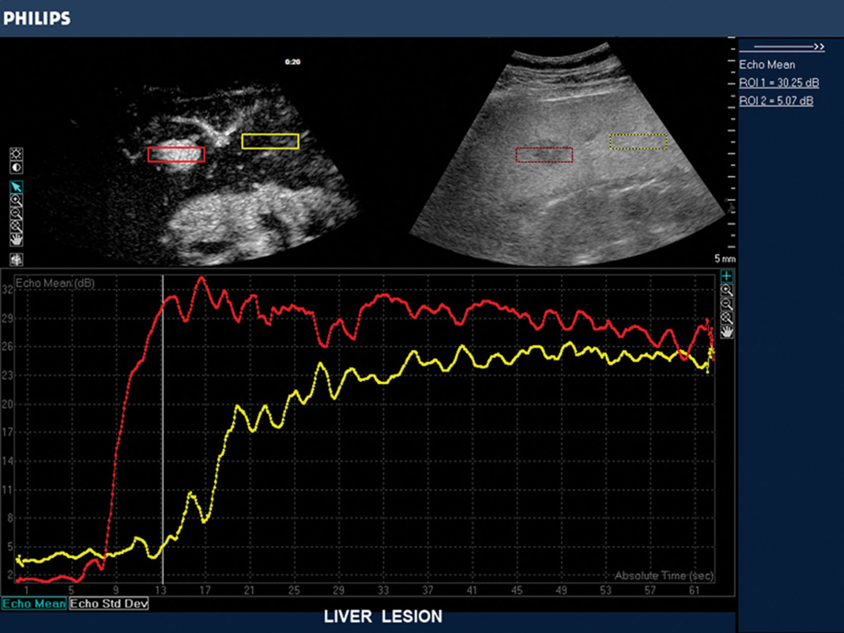 Fig. 17.8, Contrast-specific quantification of changes in signal intensity within a liver tumor compared with the normal liver. Time-intensity curves generated after intravenous administration of contrast from regions of interest placed over the tumor (red box) and the normal liver (yellow box) . The graphic displays time on the x -axis and signal intensity on the y -axis. Note that the signal intensity on the tumor (red tracing) demonstrates more rapid uptake of contrast and higher signal intensity as compared to the normal liver (yellow tracing) . Contrast enhancement can also be seen in the right kidney deep to the liver.