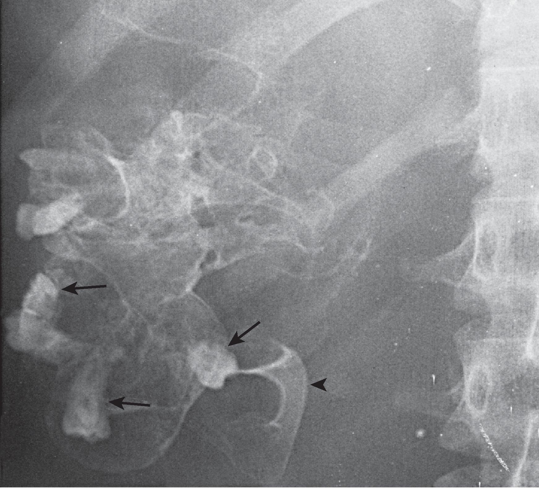 Fig. 3.1, Retroperitoneal teratoma. Both teeth ( arrows ) and bone ( arrowhead ) are visualized. Note the cortex and trabecula in the disordered pattern of ossification.