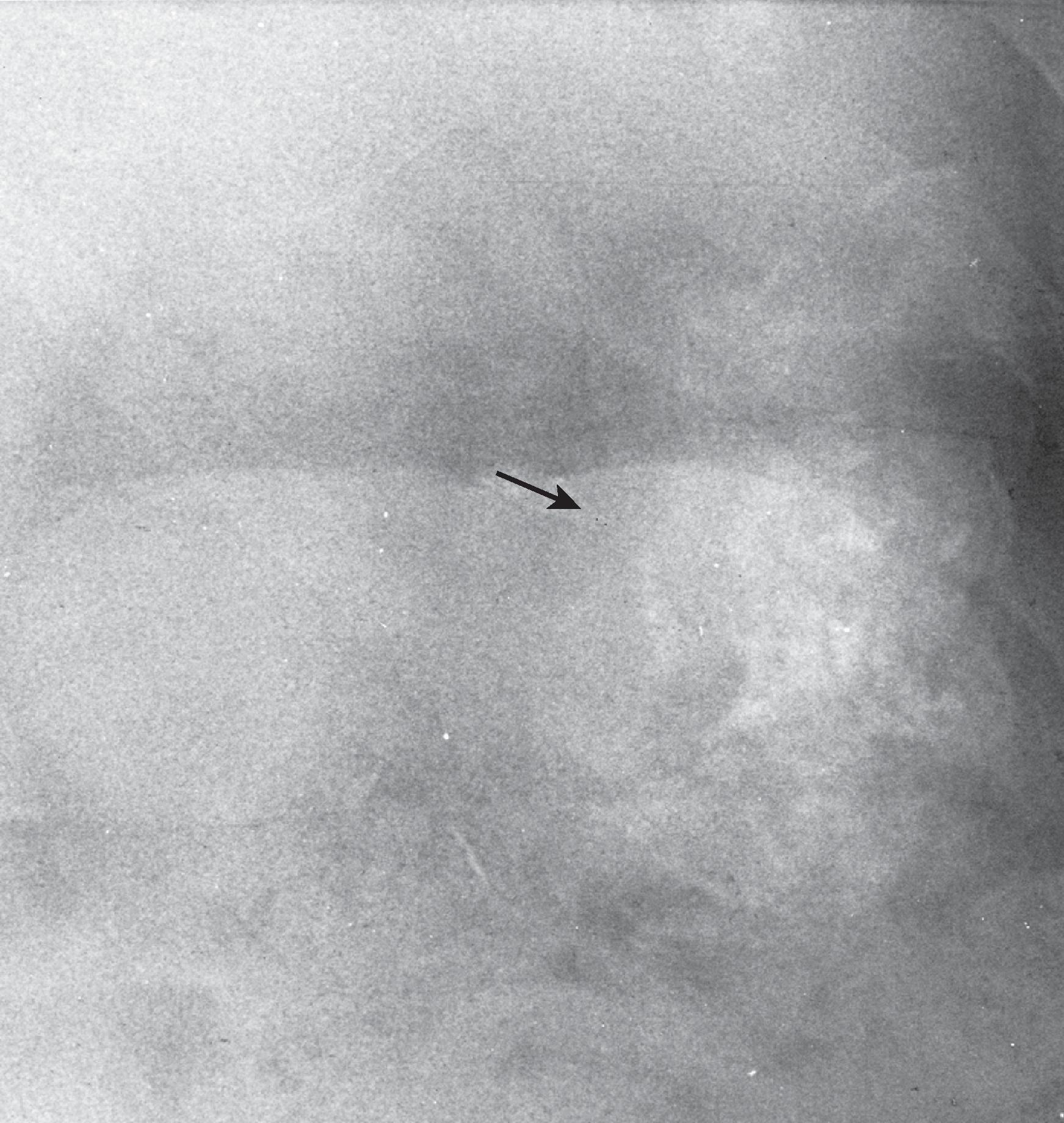 Fig. 3.2, Ovarian papillary serous cystadenocarcinoma. Patches of psammomatous calcification ( arrow ) are seen in the left abdomen in an intraperitoneal metastasis.