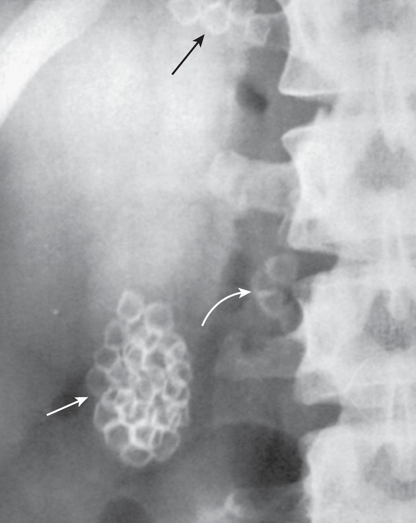 Fig. 3.3, Biliary stones. Numerous stones are seen in the gallbladder ( straight white arrow ), cystic duct ( black arrow ), and common bile duct ( curved white arrow ). Note how the stones have faceted margins.