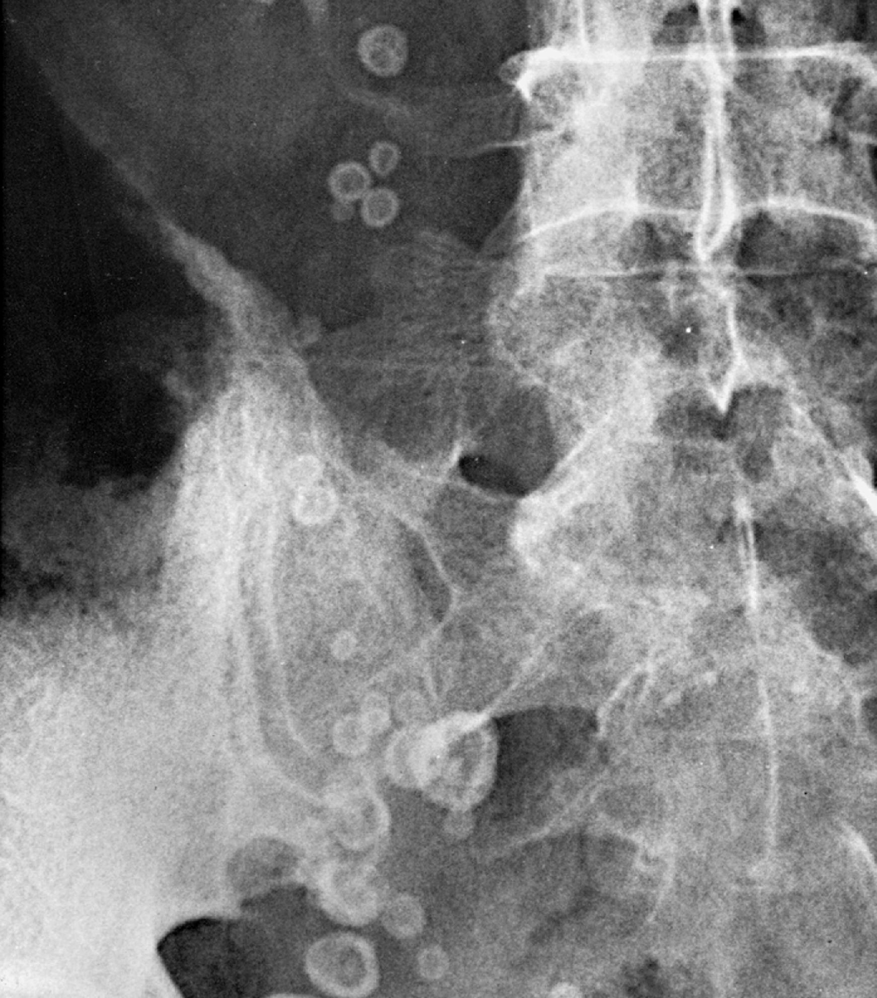 Fig. 3.4, Ovarian vein phleboliths. Numerous phleboliths, each having a central lucency, are located within a dilated right ovarian vein.