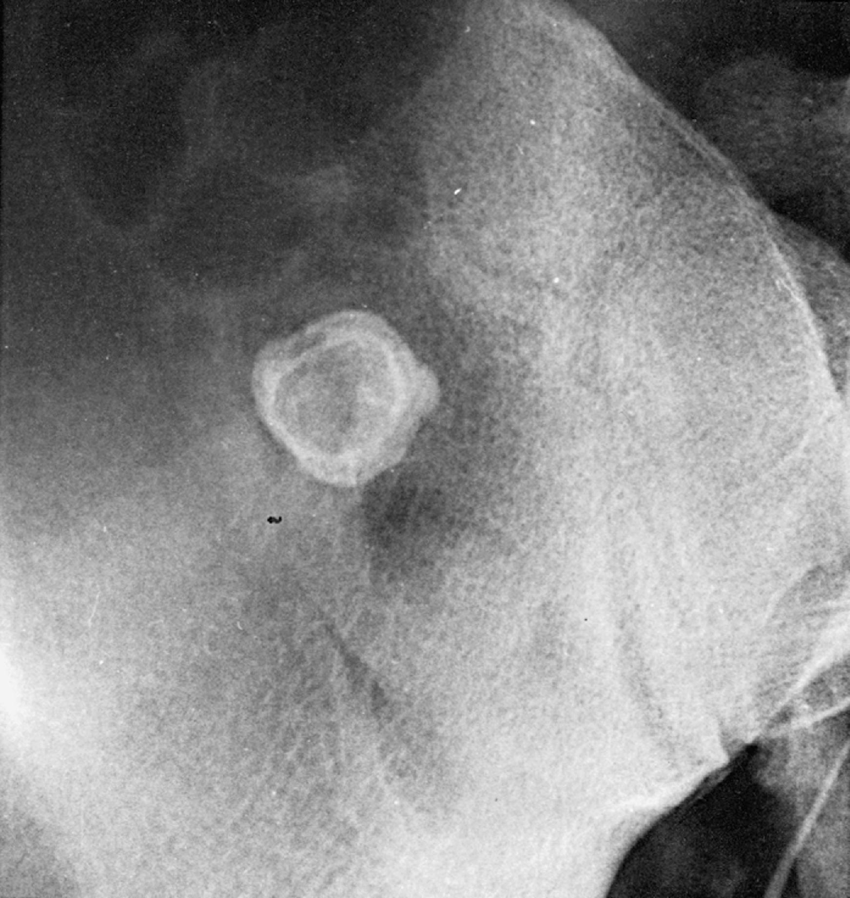 Fig. 3.5, Lamellated appendicolith. Note the continuous margin of calcification, parallel lamina, and small medial bulge along the edge of this concretion.