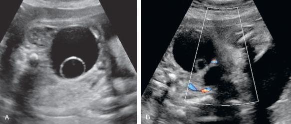 Fig. 24.1, Ovarian cyst in a female fetus at 31 weeks' gestation. (A) Transverse view of the fetal abdomen at the level of the kidney shows an anechoic cyst with another internal cyst, next to the normal ipsilateral kidney. (B) Color Doppler image shows the fetal bladder identified by the two vesical arteries.