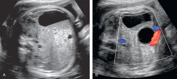 Fig. 24.2, US images of a fetal ovarian cyst with mild echogenic sediment (after internal bleeding). (A) Cross-section at the level of the ipsilateral kidney. (B) Cross-section near the fetal pelvis, next to the fetal bladder indicated by the bladder vessels.