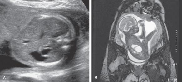 Fig. 24.3, Enteric duplication cyst. (A) US image of an enteric duplication cyst close to the fetal stomach in a fetus at 24 weeks; the accompanying Video 24.1 shows part of the neonatal endoscopic procedure to remove this duplication cyst. (B) T2-weighted MRI (sagittal section) from a similar case at 27 weeks shows a thick-walled, fluid-filled cyst juxtaposed to, but not in continuity with, the fetal stomach.