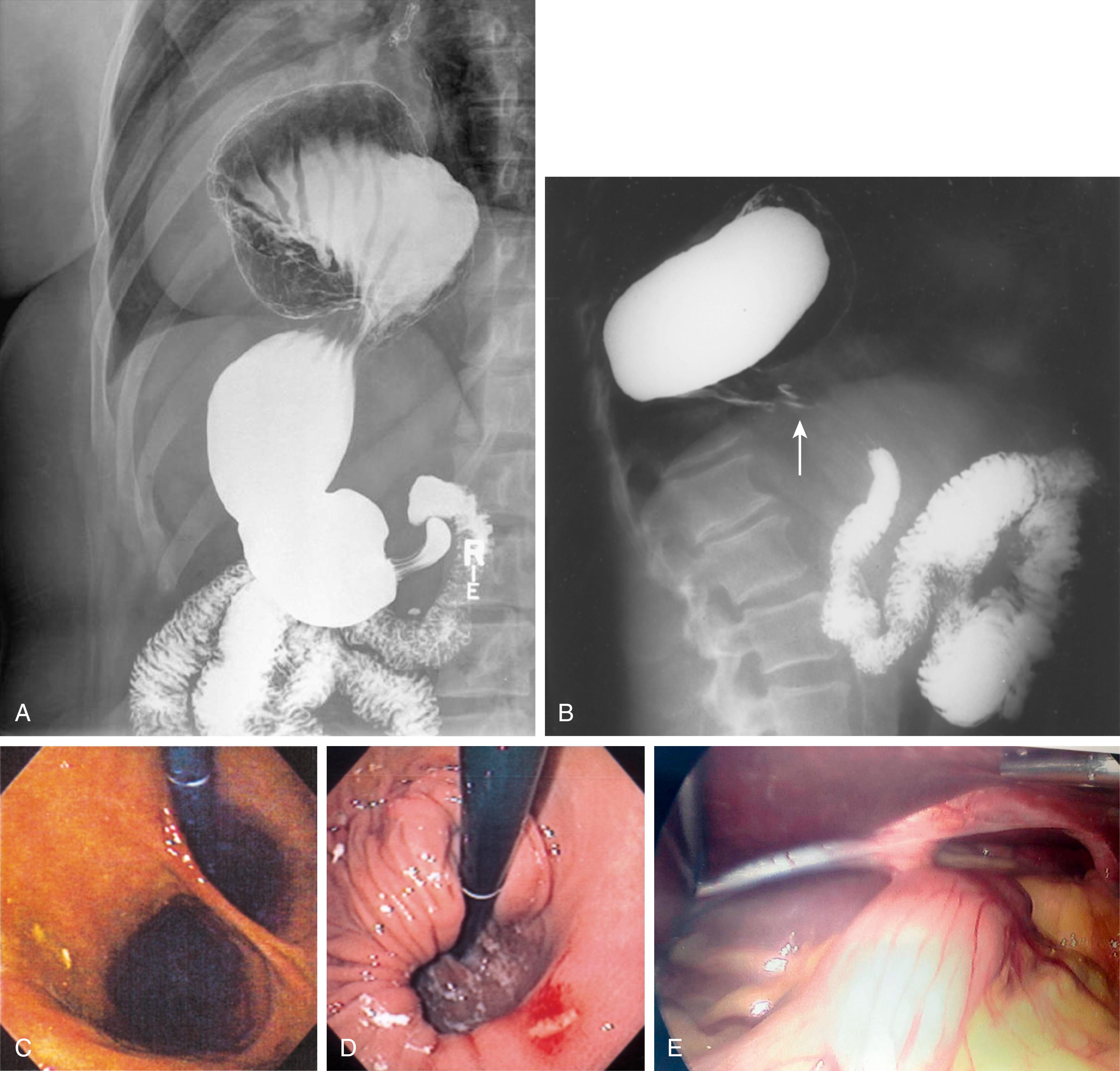 Fig. 27.1, A, Paraesophageal (type II) hernia. Barium study showing a paraesophageal hernia with a portion of the stomach above the diaphragm. B, This barium study showing a paraesophageal hernia complicated by an organoaxial volvulus of the stomach (see Fig. 27.5 ). The gastroesophageal junction remains in a relatively normal position below the diaphragm ( arrow ). C, The retroflexed endoscopic view of the proximal stomach demonstrates the endoscope traversing a sliding hiatal hernia adjacent to a large paraesophageal hernia. D, Cameron lesion. A large hiatal hernia is seen on endoscopic retroflexed view, with a Cameron lesion at the level of the diaphragmatic hiatus at the 5-o’clock position. E, Laparoscopic view of a paraesophageal hernia.