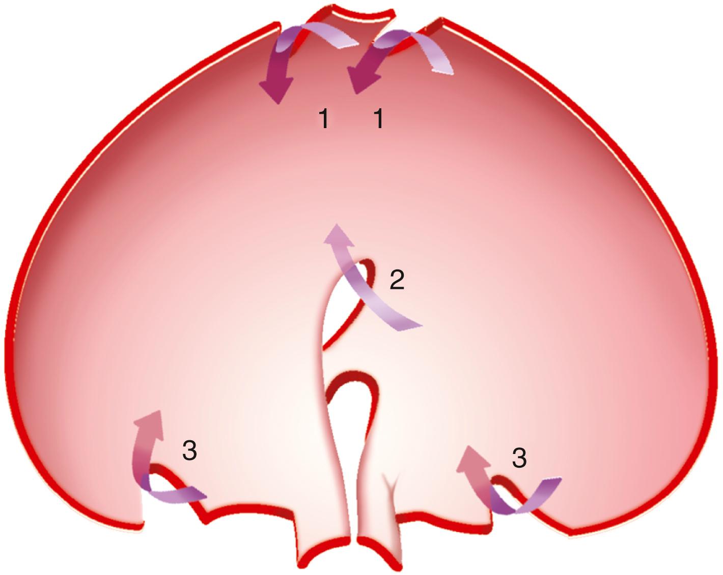 Fig. 27.2, Congenital diaphragmatic hernias. Diagram of the diaphragm viewed from below with areas of potential herniation shown. 1, Sternocostal foramina of Morgagni anteriorly. 2, Esophageal hiatus. 3, Lumbocostal foramina of Bochdalek posteriorly. Arrows indicate the direction of herniation.