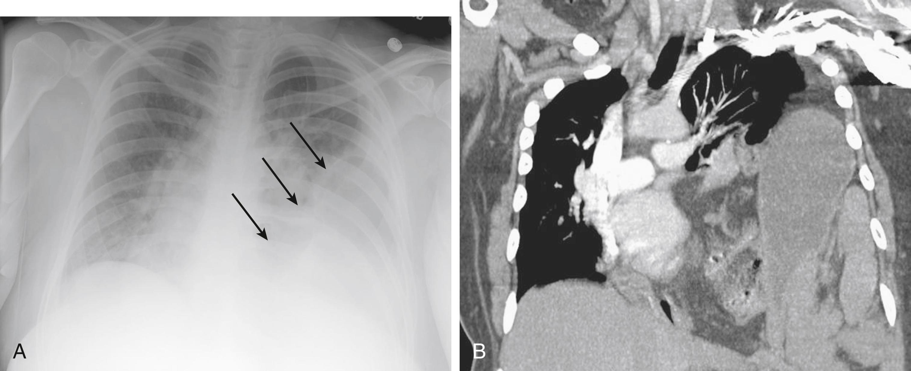 Fig. 27.3, Bochdalek hernia. A, This plain chest film shows a Bochdalek hernia as a small opacity in the posterior chest at the level of the diaphragm, with bowel in the left chest ( arrows ). B, CT of the same patient showing bowel above the diaphragm and causing a mediastinal shift.