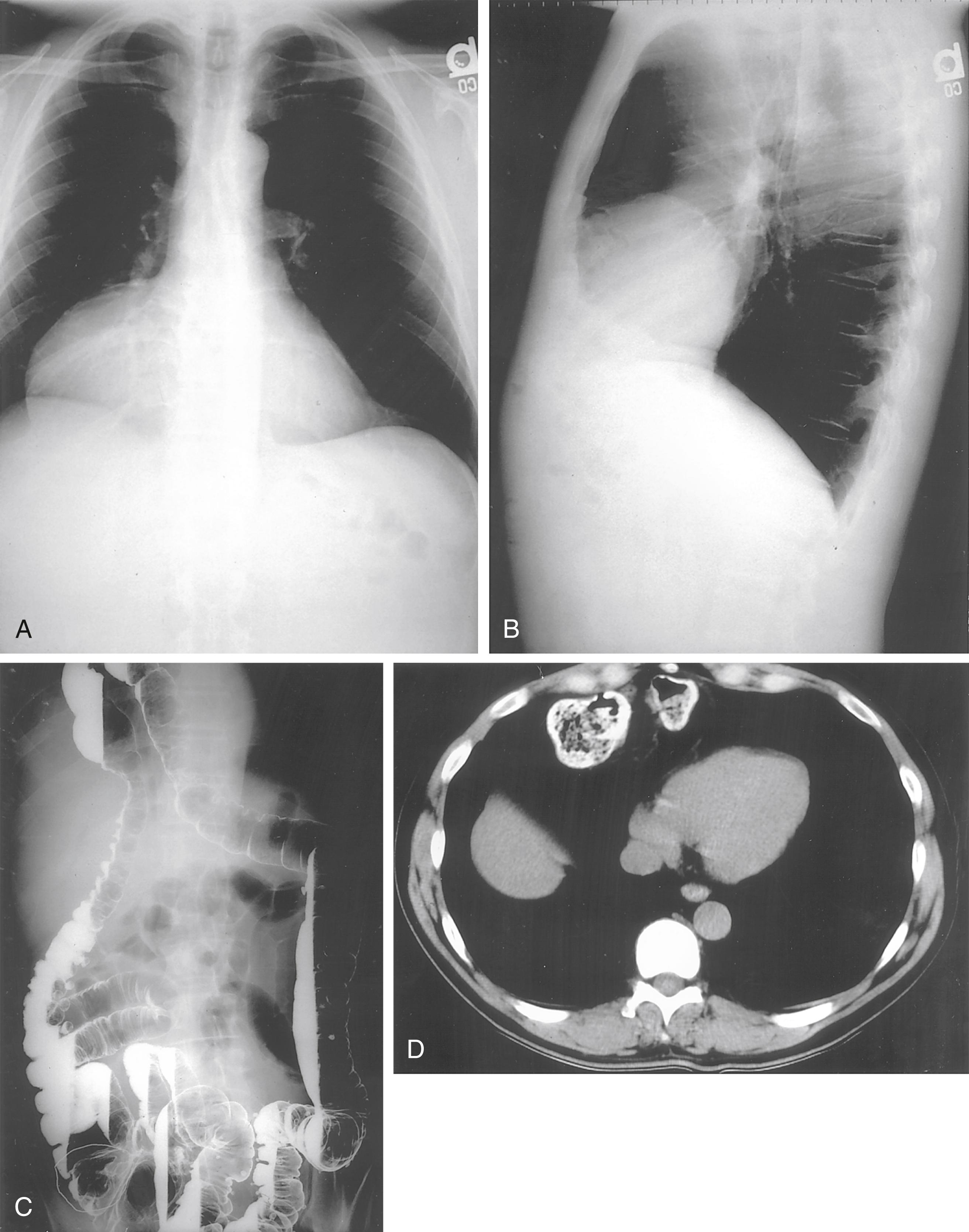 Fig. 27.4, Morgagni hernia. A, A mass is noted in the right chest on a chest film (posteroanterior view). B, Lateral chest film shows that the mass is in the anterior chest. C, Barium enema shows that a portion of the transverse colon is the hernia ( top left ). D, CT shows a contrast-filled colon in the right anterior chest (11-o’clock position).