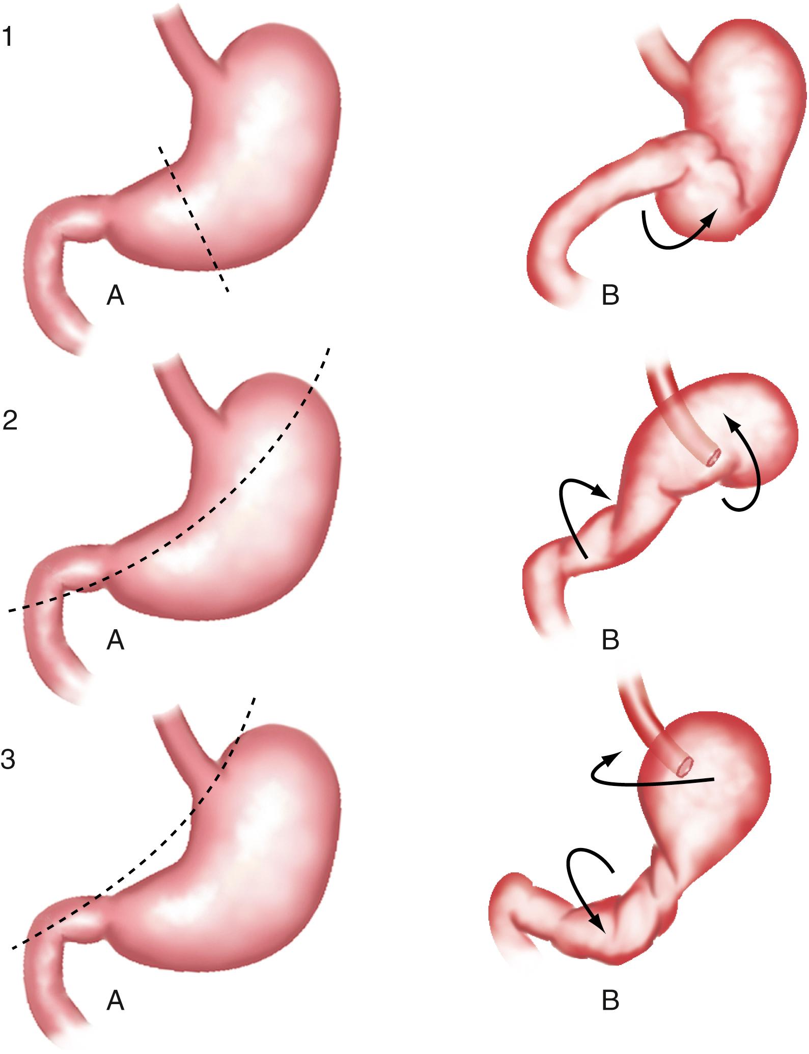 Fig. 27.5, Pathogenesis of gastric volvulus. 1A, Axis for potential mesenteroaxial volvulus bisecting the lesser and greater curvatures. 1B, Mesenteroaxial volvulus resulting from anterior rotation of the antrum along this axis. 2A, Axis for potential organoaxial volvulus passing through the body of the stomach. 2B, Organoaxial volvulus resulting from anterior-superior rotation of the antrum along this axis. 3A, Axis for potential organoaxial volvulus passing through the gastroesophageal junction and the pylorus. 3B, Organoaxial volvulus resulting from anterior-superior rotation of the antrum and posterior-inferior rotation of the fundus along this axis.