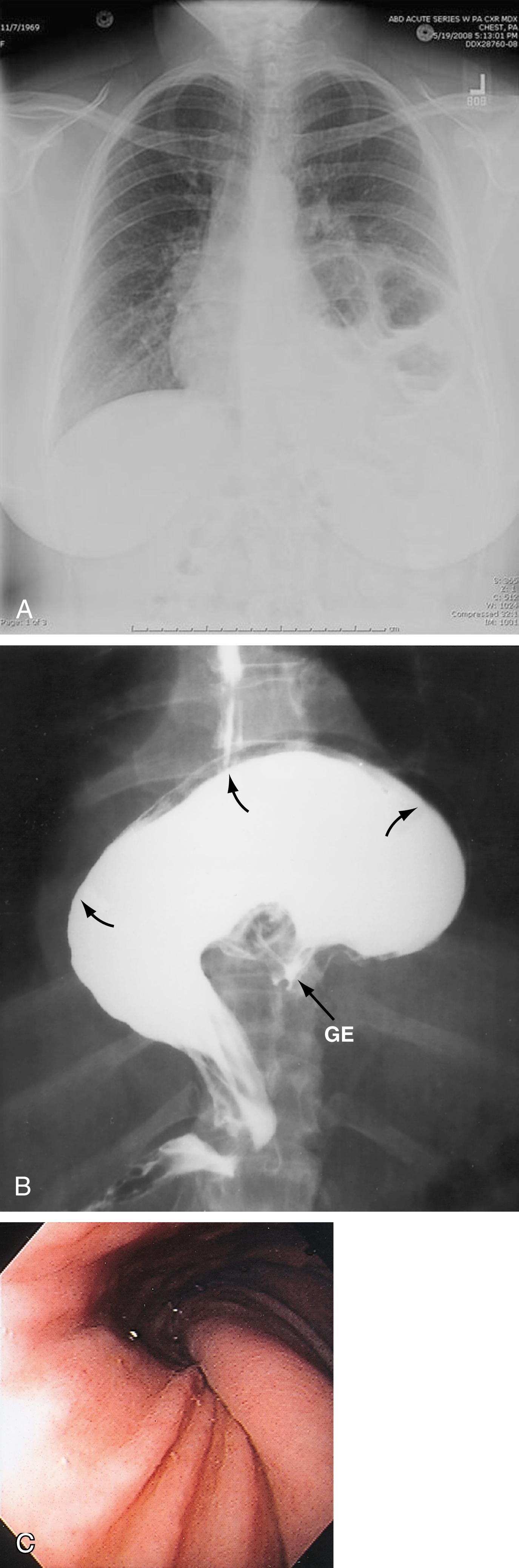Fig. 27.6, Gastric volvulus with paraesophageal hernia. A, Chest film showing a gas-filled mediastinal mass. B, Barium examination showing that the greater curvature and lesser curvature of the stomach are reversed in position (upside-down stomach). C, Twisting of the gastric folds at the point of torsion is noted in this endoscopic view of a gastric volvulus.