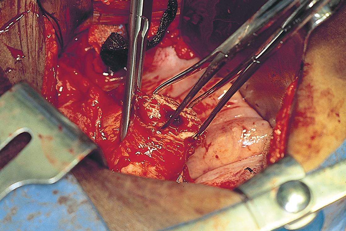 FIG. 13.22, A straight Zeppelin clamp is placed across the bottom of the cardinal ligament with the point of the clamp angled within the pubovesicocervical fascia. Clamping within the fascial layer prevents injury to the bladder and ureters.