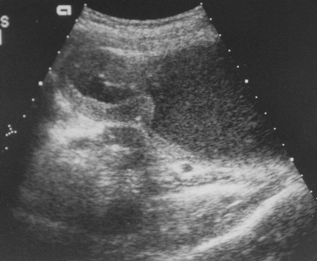 Fig. 20.3, An ultrasonic longitudinal view of the pelvis reveals hydrometrocolpos. The uterus and cervix are readily seen superior to the large collection of fluid in the vagina located at the right of the image.