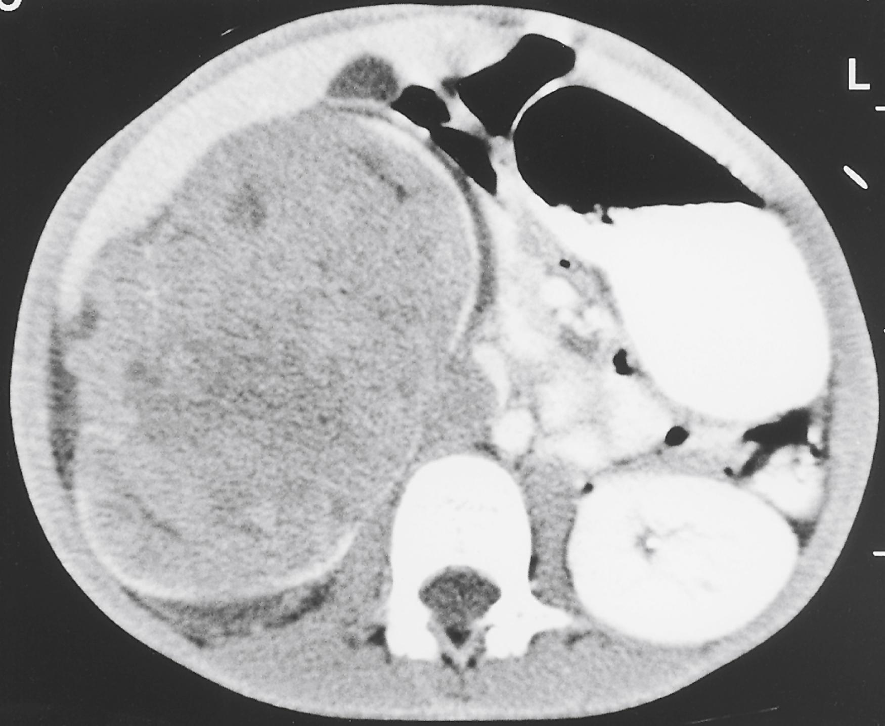 Fig. 20.4, CT revealing a large Wilms tumor replacing the right kidney. Notice that the renal cortex, enhanced by contrast medium, is splayed out around the mass. This characteristic helps differentiate Wilms tumor from neuroblastoma, which would displace a normal-appearing kidney.