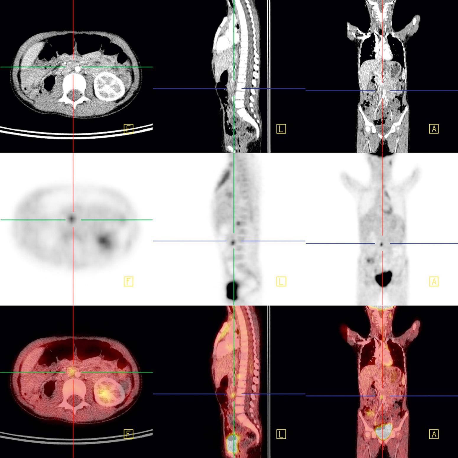 Fig. 20.5, Recurrent anaplastic Wilms tumor with multiple sites of 18 F-fluorodeoxyglucose (FDG)-avid disease. Standard CT scan (top) . PET scan (middle) . PET/CT scan (bottom) .