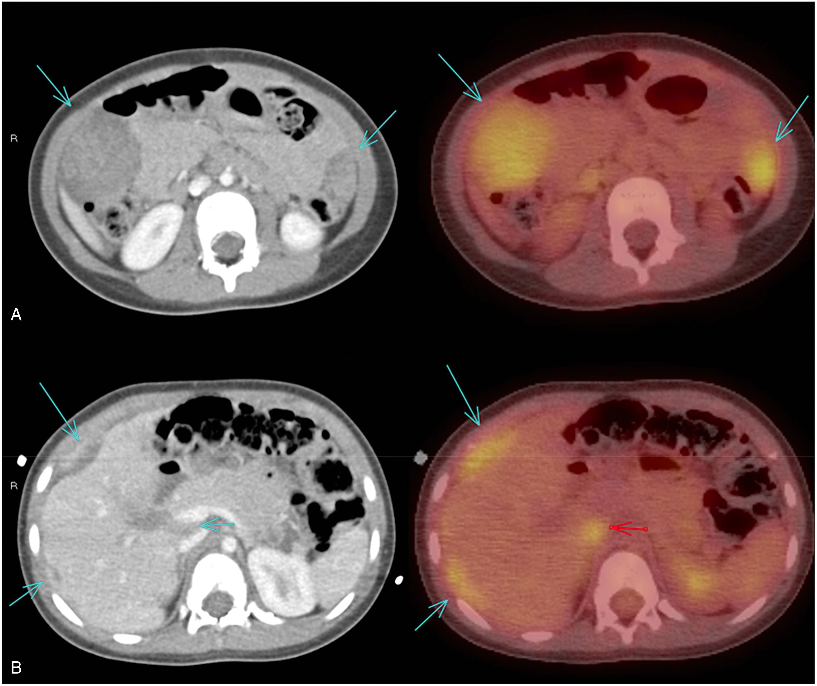 Fig. 20.6, CT ( A ) and PET/CT ( B ) of the abdomen and pelvis, showing multiple FDG-avid peritoneal masses throughout the abdominal cavity.