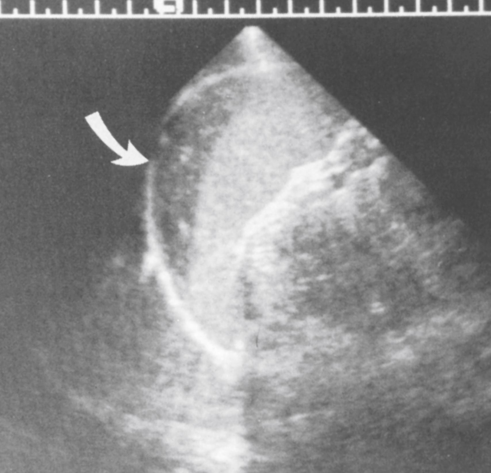 Fig. 20.7, The subcapsular splenic hematoma (arrow) in a 15-year-old boy who had been in a motor vehicle crash was best seen on coronal scans through the left intercostal spaces.