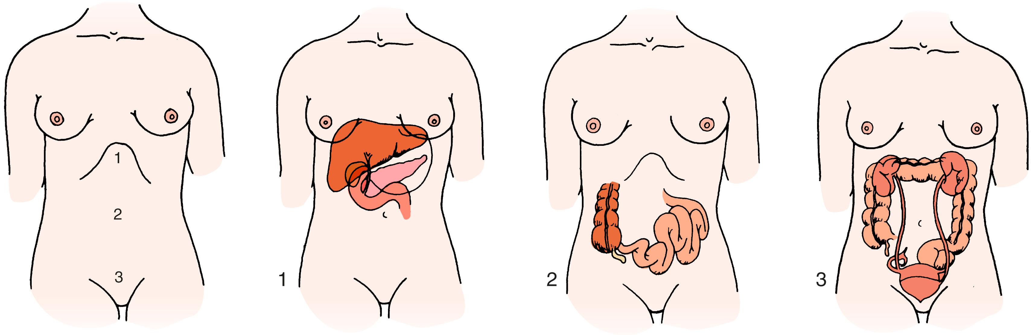 Fig. 13.1, “Visceral” abdominal pain: deep, dull, diffuse. The three general localizations of midline “visceral” abdominal pain are epigastric (1) , periumbilical (2) , and hypogastric (3) . 1, Epigastric pain usually suggests disease of the thorax, stomach, duodenum, pancreas, liver, or gallbladder. 2, Periumbilical pain usually implies disease of the small intestine, cecum, or both. 3, Hypogastric pain usually implicates the large intestine, pelvic organs, or urinary system.