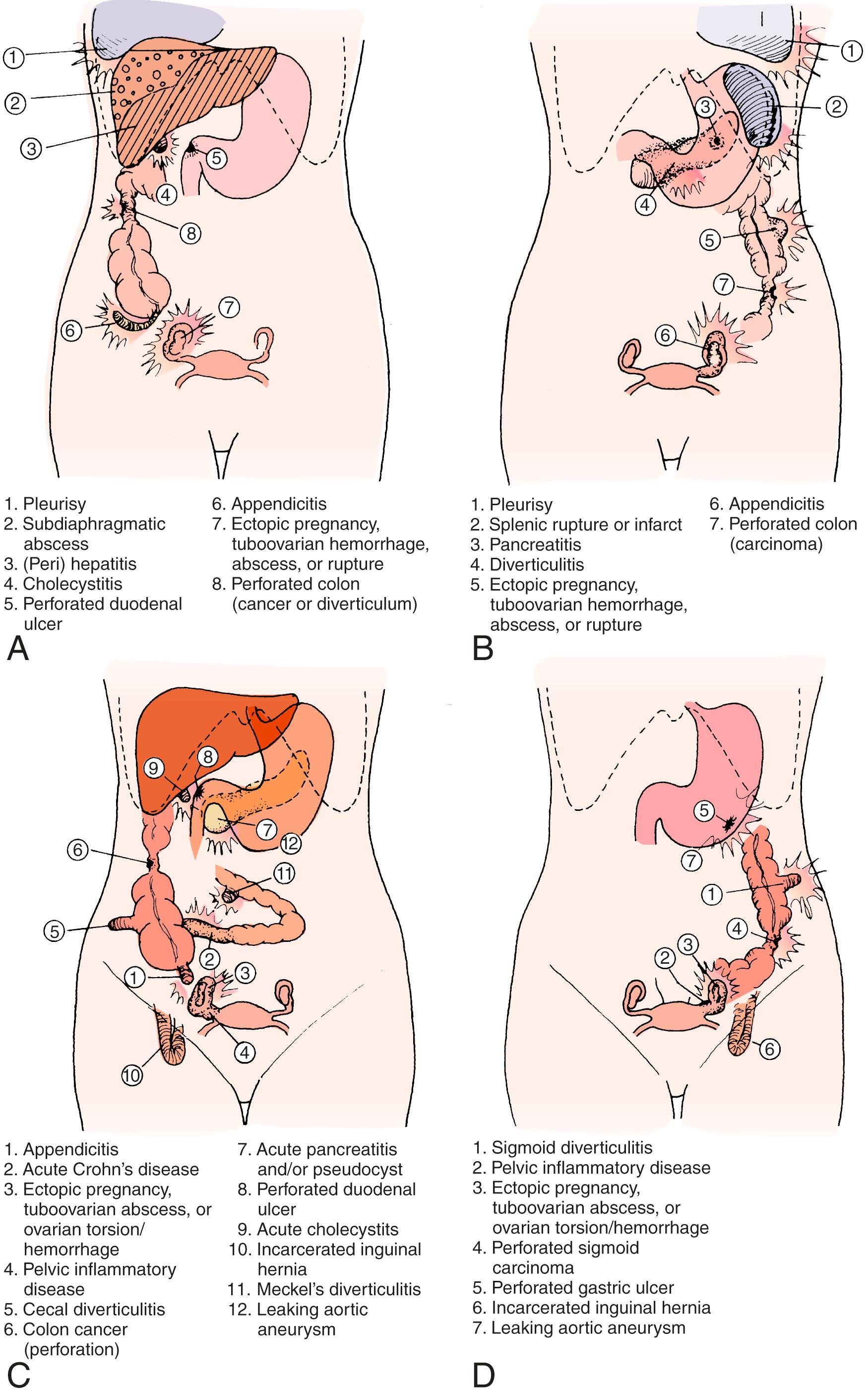 Fig. 13.2, Common and uncommon conditions that may cause “parietal” pain and localized peritonitis in the various quadrants of the abdomen. A, Right upper quadrant. B, Left upper quadrant. C, Right lower quadrant. D, Left lower quadrant.