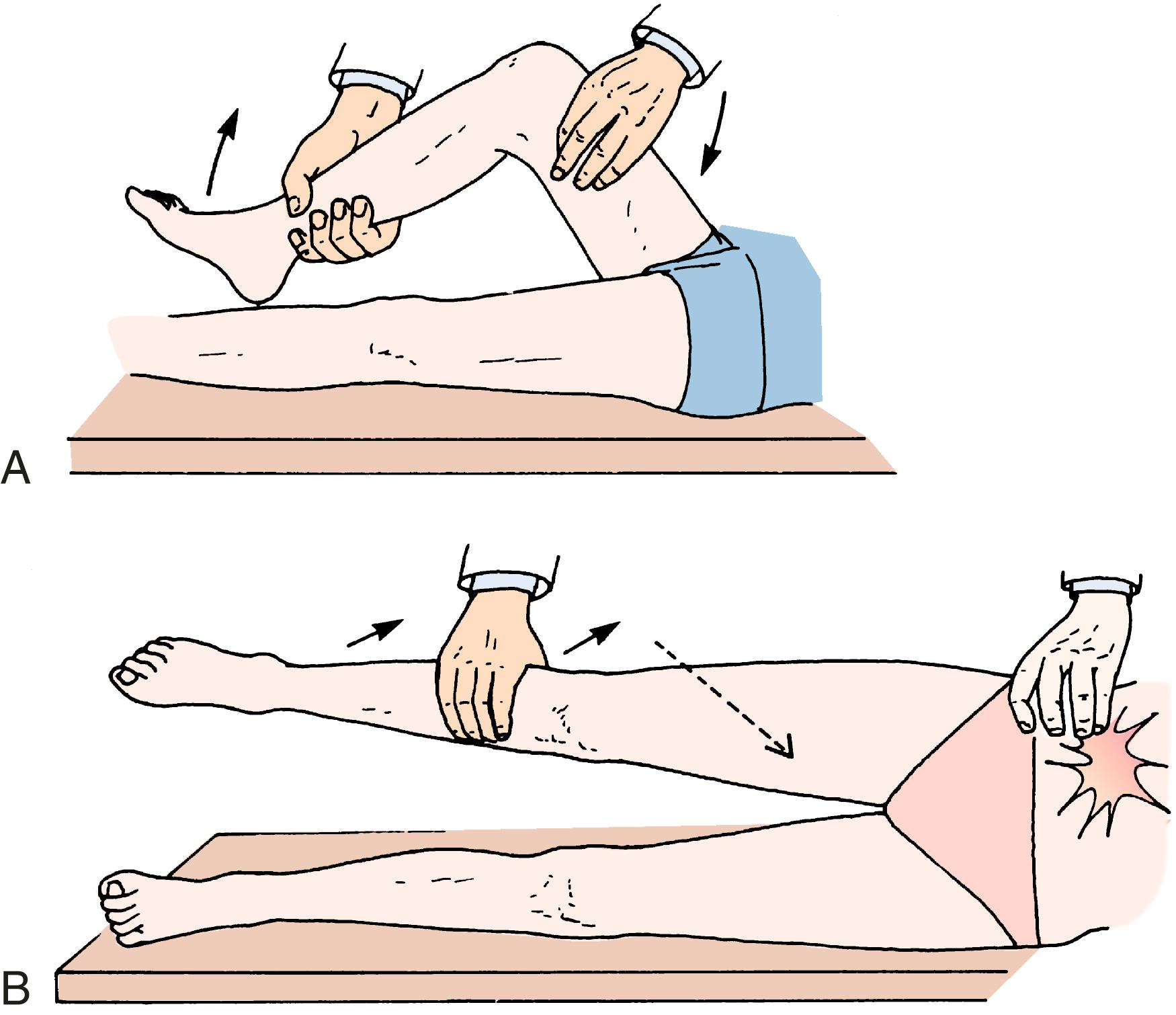 Fig. 13.3, A, The obturator sign. Pain occurs when the hip is flexed and rotated. Internal rotation is most likely to cause pain as a result of pelvic or retroperitoneal disease or both. B, The psoas sign. The test may be performed passively or actively. The hip is passively extended, thus stretching the psoas muscle (solid arrow) . The hip is actively flexed usually against resistance, thus tensing the psoas muscle (dotted arrow) .